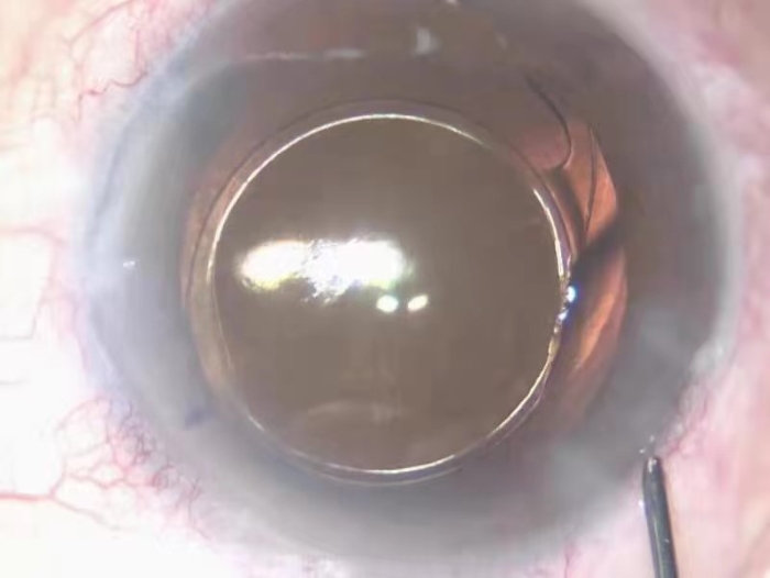 愛博諾德（北京）醫(yī)療科技有限公司+人工晶狀體(2)